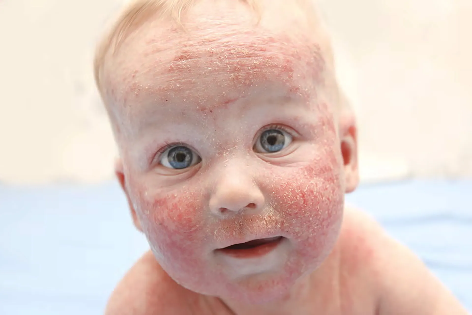 Baby with eczema rash on face — atopic dermatitis in infants