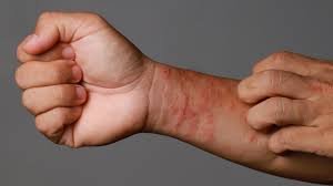 Eczema skin irritation showing redness and inflammation on arm
